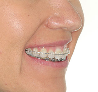 South Charlotte Braces | Braces Charlotte