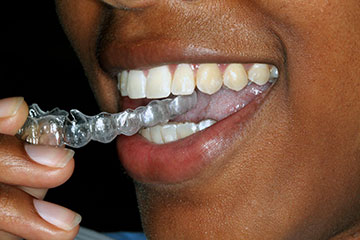 Charlotte Invisalign | South Charlotte Invisalign 