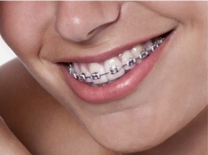 Charlotte Braces | South Charlotte Braces